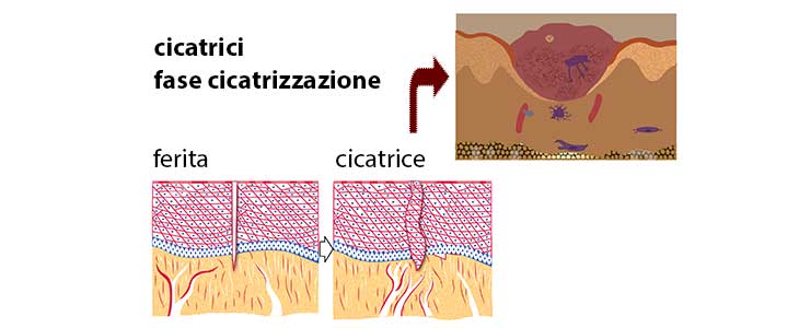 Cicatrici fasi di cicatrizzazione