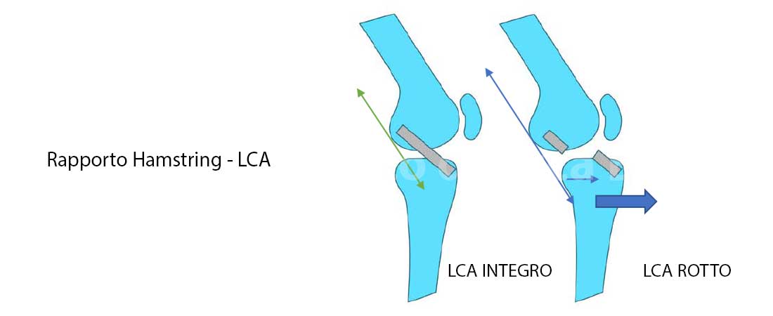 Il rinforzo ischiocrurali post ricostruzione LCA